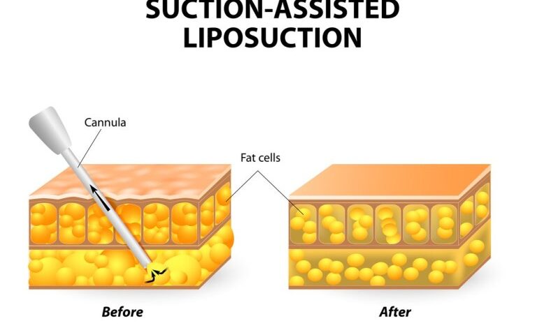 Liposuction