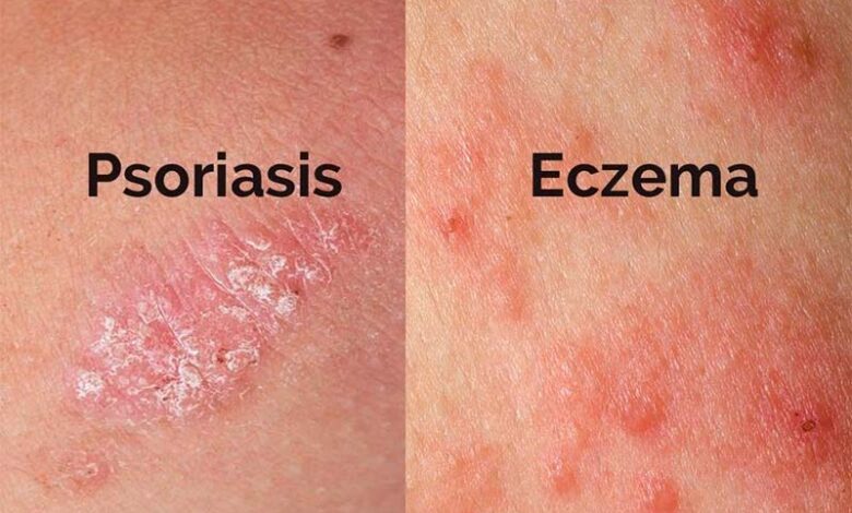 Psoriasis