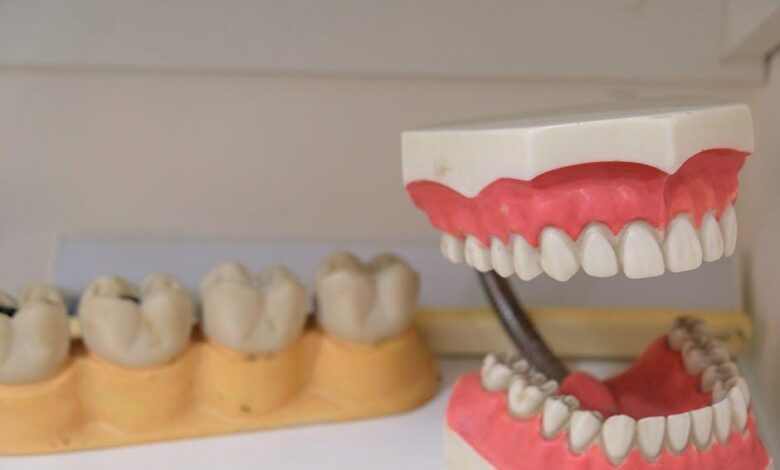 Denture Implants